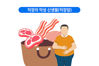 직장암