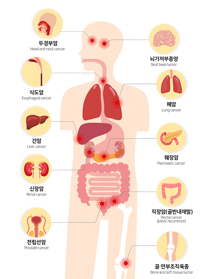 연세의료원 중입자치료 대상 암종