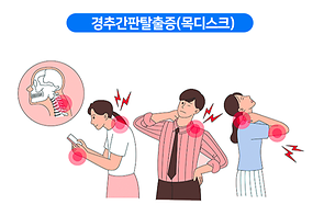 경추간판탈출증(목디스크)